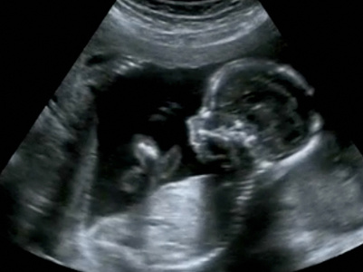 Bei normalem Schwangerschaftsverlauf sind drei Sonografien vorgesehen
